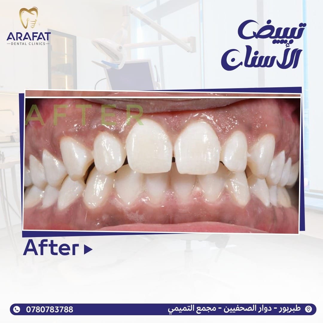 تبييض الأسنان في طبربور - أفضل عيادة أسنان في طبربور - عيادات عرفات لطب الأسنان - Arafat Dental Clinics تبييض الأسنان في أفضل عيادة أسنان في عمان