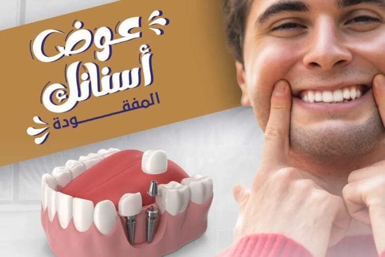 زراعة الأسنان في طبربور - أفضل عيادة أسنان في طبربور - عيادات عرفات لطب الأسنان - Arafat Dental Clinics زراعة-الأسنان-في-طبربور