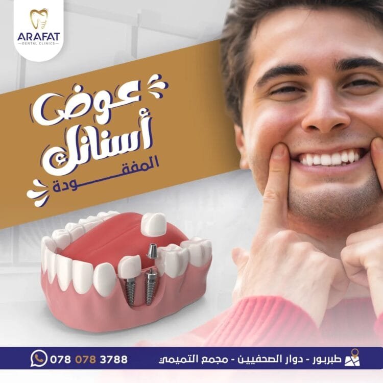 زراعة الأسنان في طبربور - أفضل عيادة أسنان في طبربور - عيادات عرفات لطب الأسنان - Arafat Dental Clinics زراعة-الأسنان-في-طبربور
